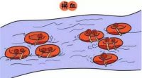 新生儿溶血性黄疸怎么治疗 什么是溶血性黄疸