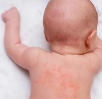 婴幼儿夏季“防痱“指南